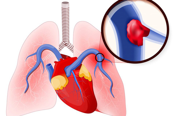 Nguyên nhân gây tăng áp động mạch phổi
